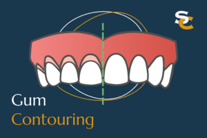 gum contouring